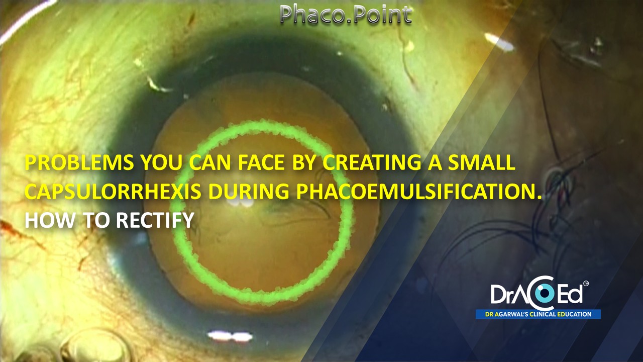 Problems you can face by creating a small Capsulorrhexis during Phacoemulsification