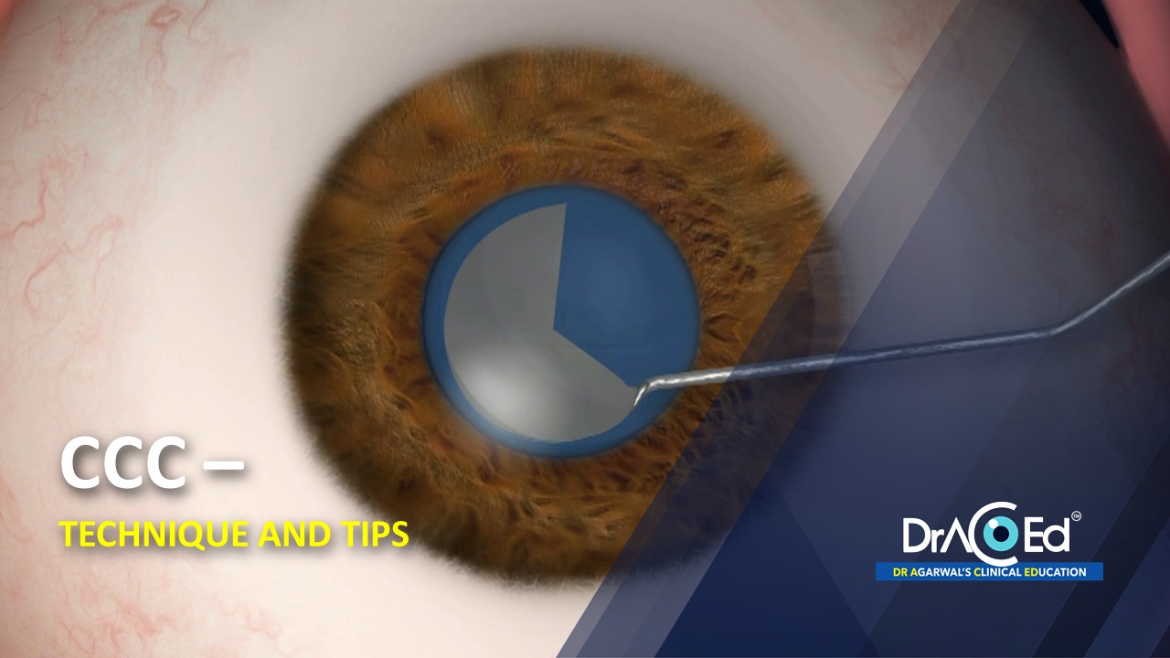 CCC – TECHNIQUE AND TIPS