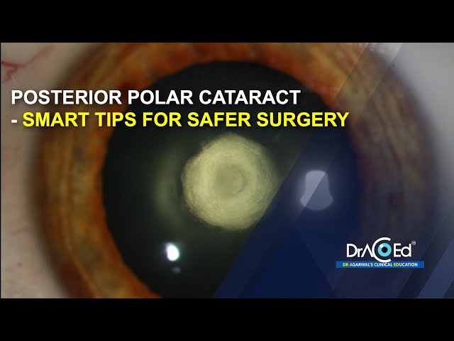 Posterior Polar Cataract - Smart Tips for Safer Surgery