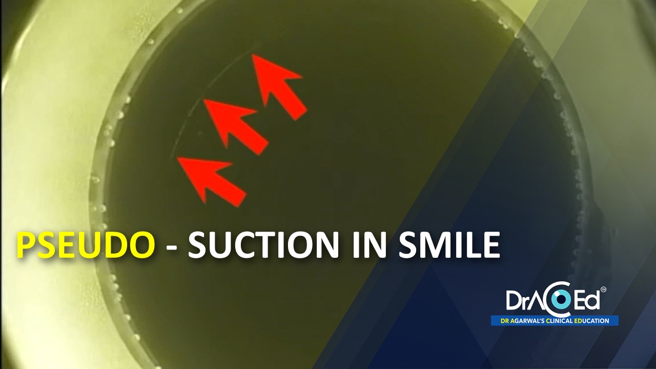 PSEUDO - SUCTION IN SMILE