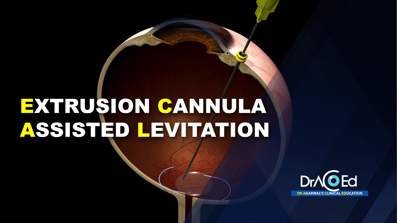 Extrusion Cannula Assisted Levitation