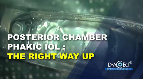 Posterior Chamber Phakic IOL - The Right Way Up