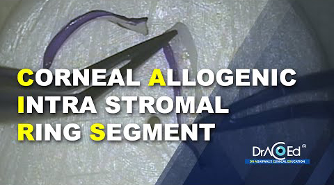 CORNEAL ALLOGENIC INTRA STROMAL RING SEGMENT