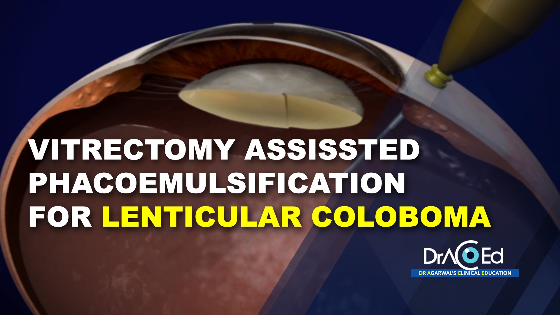 Vitrectomy Assissted Phacoemulsification for Lenticular Coloboma