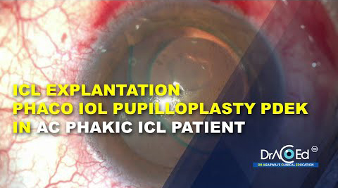 ICL explantation + Phaco IOL + pupilloplasty + PDEK in a complicated AC phakic ICL patient