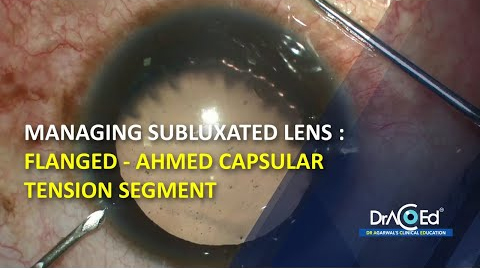 Managing subluxated lens : Flanged Ahmed capsular tension segment