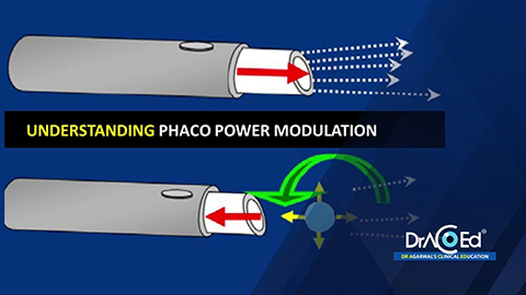 Prof.Venkatesh | Understanding Phaco power modulation