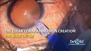 The clear Corneal Incision Creation THE RULE OF '30' | Prof. Venkatesh Suvira