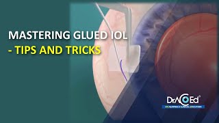 Mastering Glued IOL - Tips and Tricks