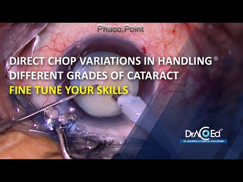 Direct Chop Variations in handling Different Grades of Cataract Fine tune your Skills