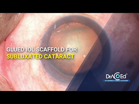 Glued IOL Scaffold for Subluxated Cataract