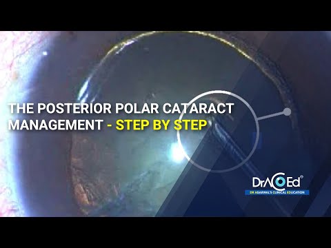 The Posterior Polar Cataract management - Step by Step