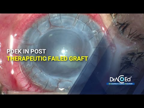 PDEK in post therapeutic failed graft