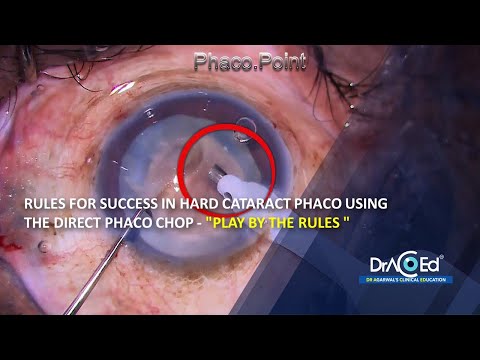 Rules for Success in Hard Cataract Phaco using the Direct Phaco Chop - 